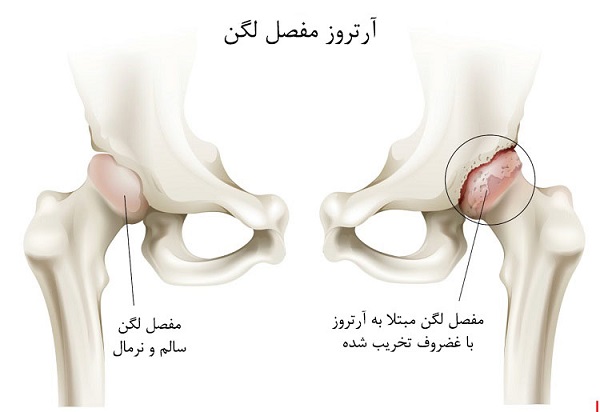 آرتروز لگن - آسان درمان