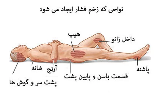 زخم بستر