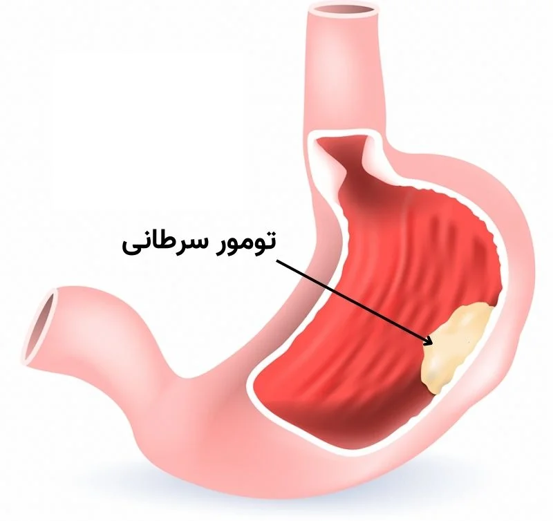 ُرطان معده