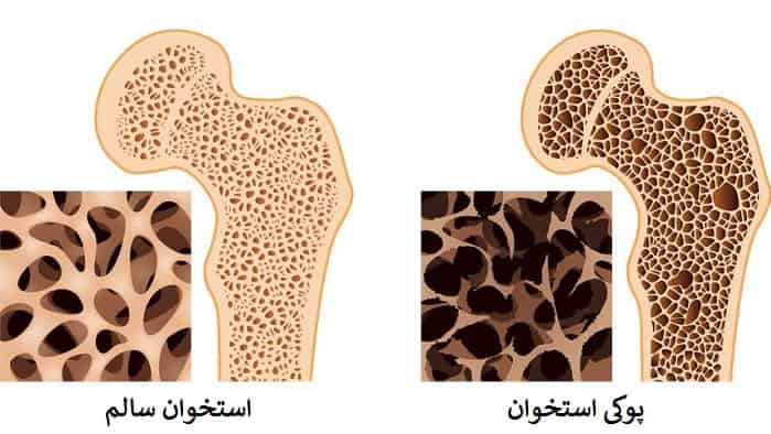 پوکی استخوان-آسان درمان