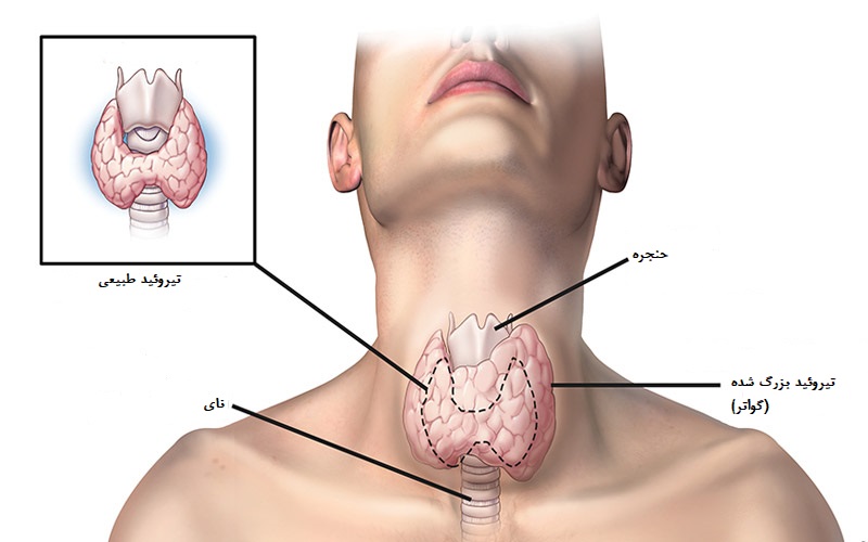 پر کاری تیروئید - آسان درمان