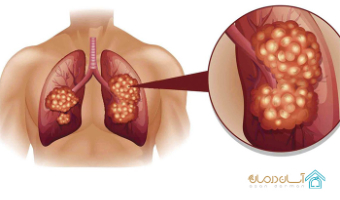علائم سرطان ریه چیست و چگونه درمان میشود؟