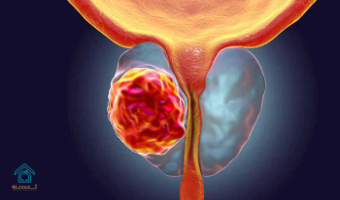 سرطان پروستات چیست و چه علائمی دارد؟