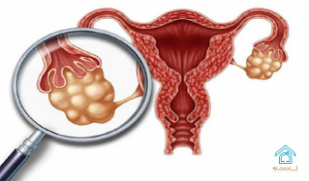 تنبلی تخمدان یا سندرم تخمدان پلی کیستیک چیست؟