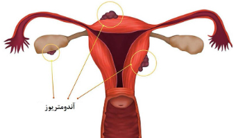 علائم و درمان آندومتریوز