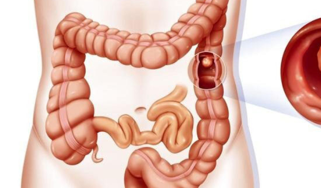 انسداد روده چیست و چه علت و درمانی دارد؟